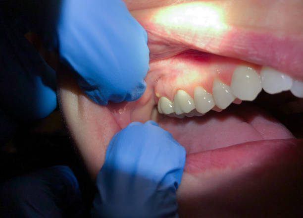 Best Emergency Tooth Extraction in Wake Village, TX